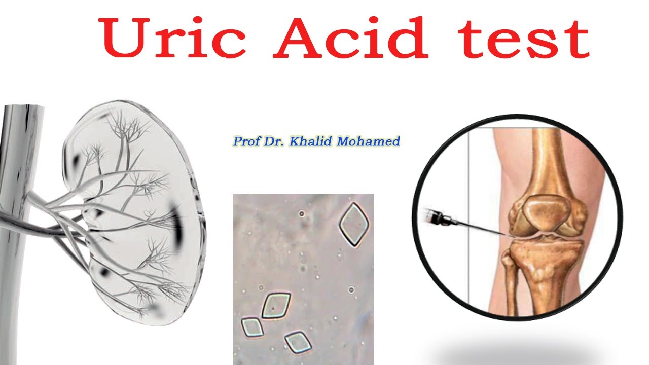 Uric acid test: Made Easy تحليل حمض اليوريك وعلاقته بالنقرص ووظائف الكلي
