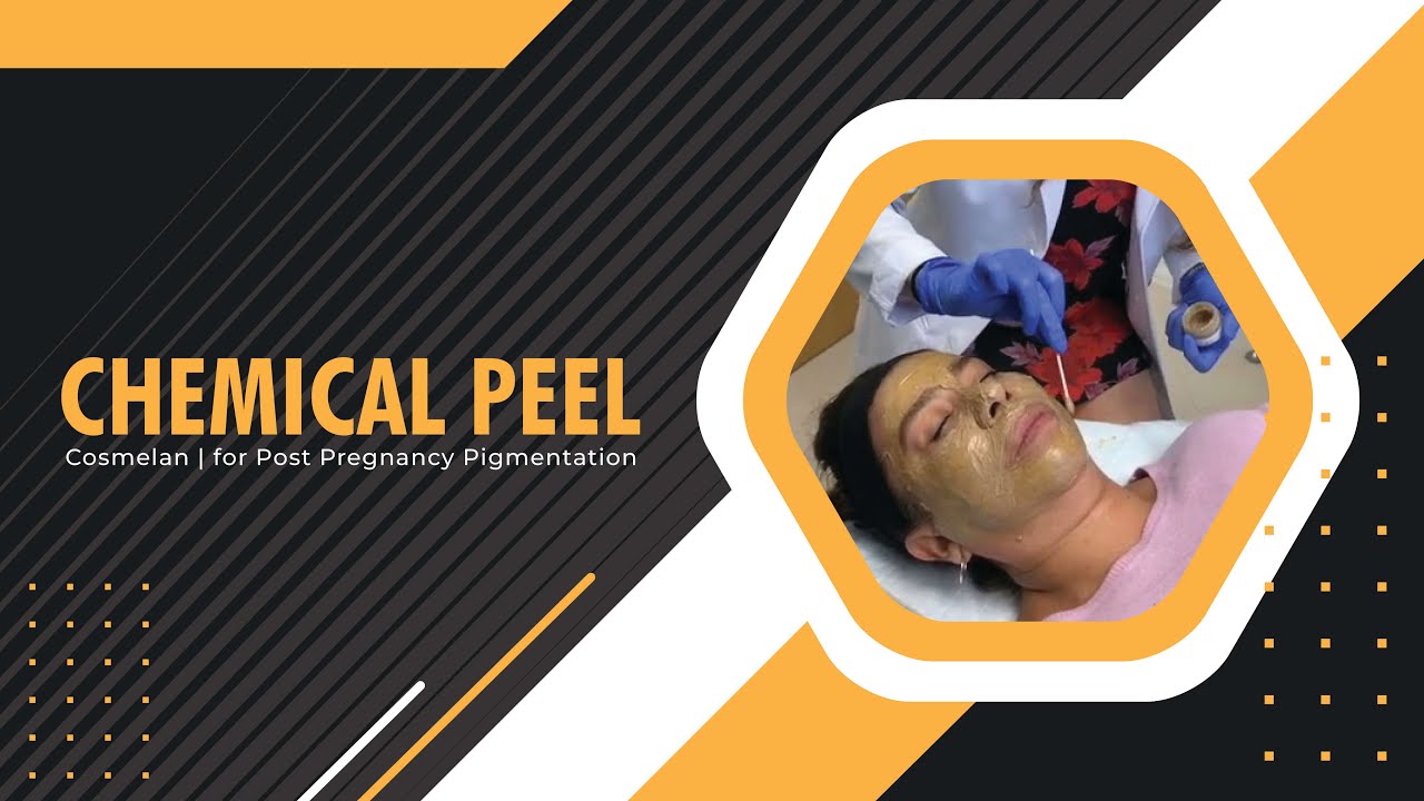 Chemical Peel | Cosmelan | for Post Pregnancy Pigmentation | West Hollywood, CA | Dr. Jason Emer