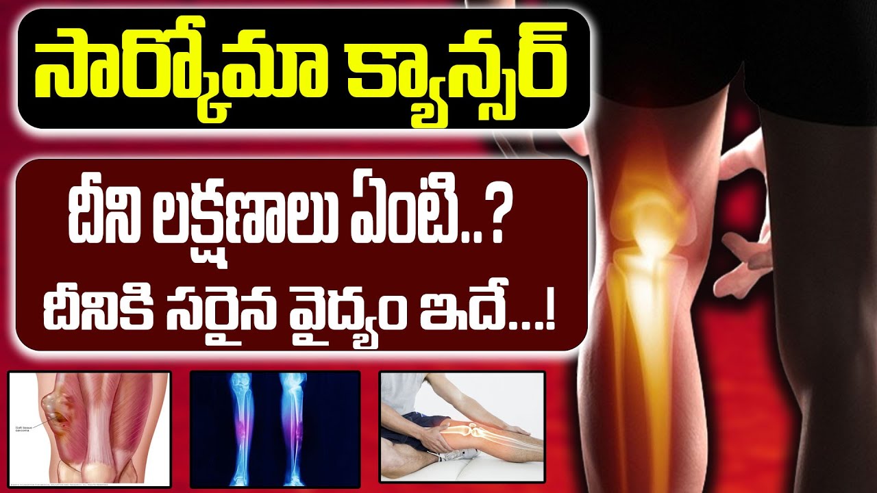 సార్కోమా క్యాన్సర్‌ అంటే ఏంటి.? | What is sarcoma cancer.? | Sarcoma Cancer Cure | @CVRHealth