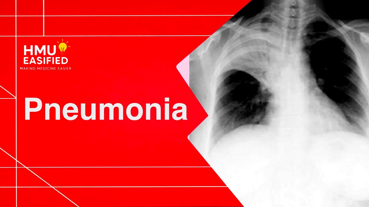 Medicine: Pneumonia