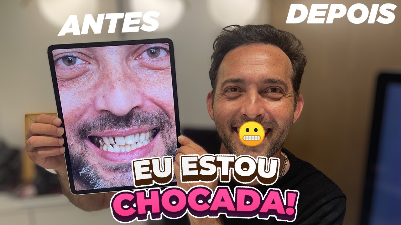 FIZEMOS UMA TRANSFORMAÇÃO NOS DENTES DO MEU IRMÃO!!