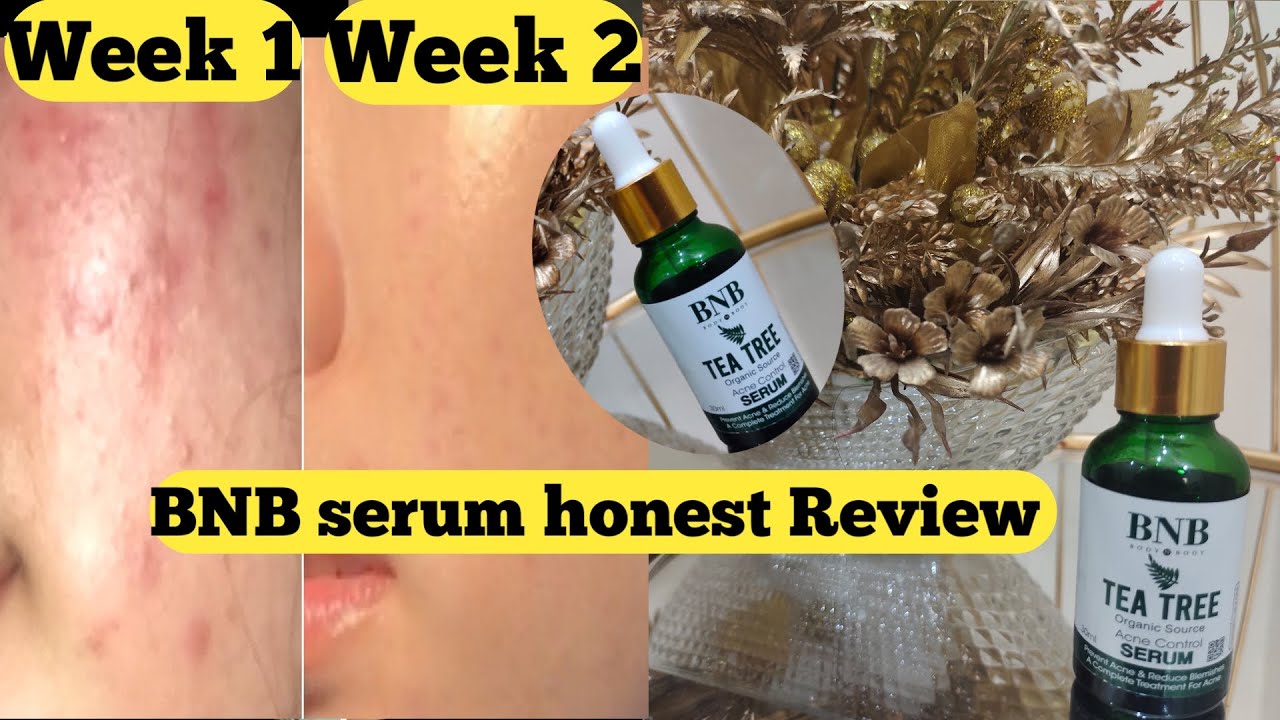 BNB acne serum review 💯 Pharmacy serum for acne prone skin| #bnb #skincare #dailyvlog #viral