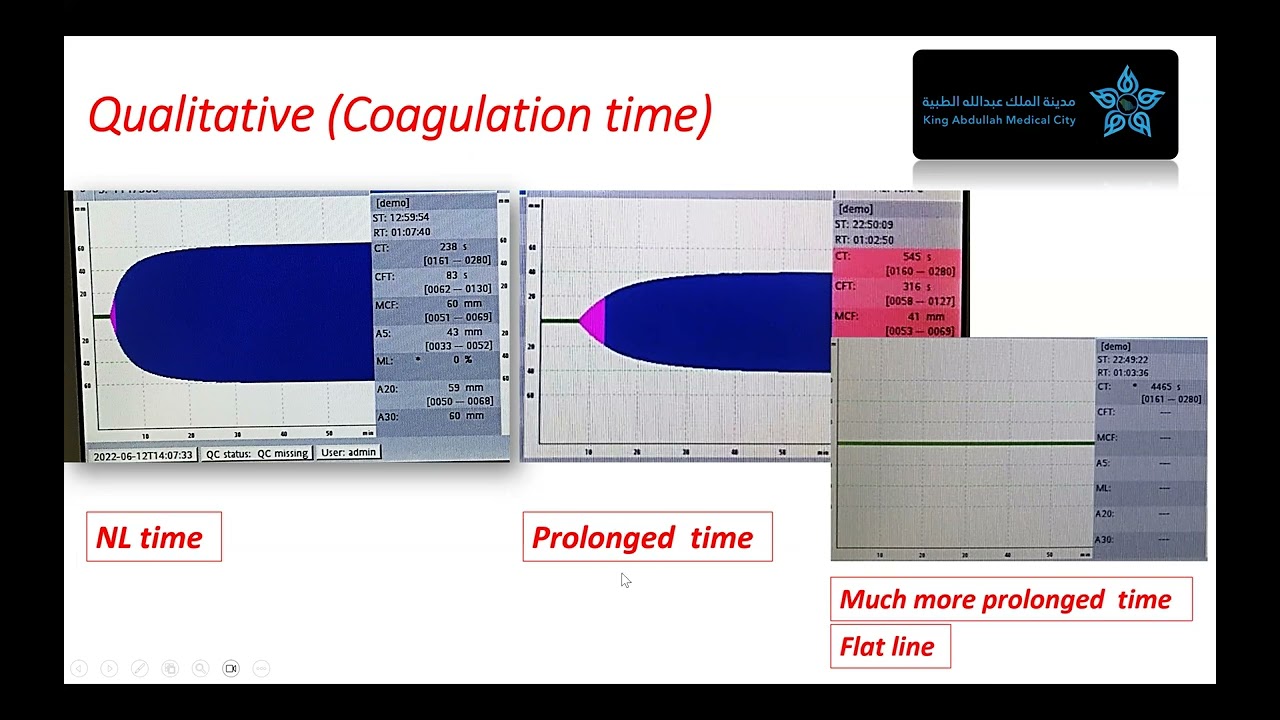 ROTEM interpretation with real cases part 1