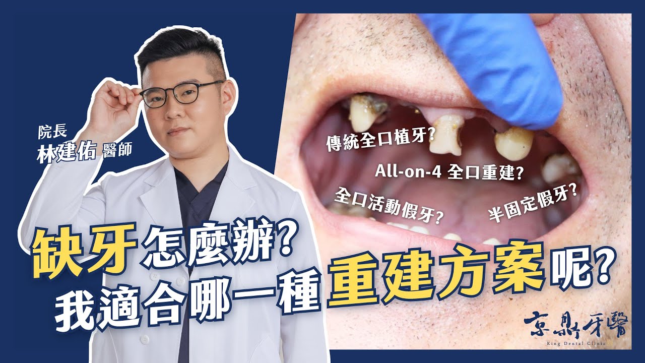 【缺牙很多怎麼辦？我適合哪一種重建方案呢？】MVP牙醫-林建佑醫師