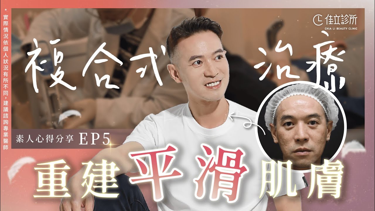 【凹疤治療見證】填平凹疤，找回自信眼神｜佳立診所