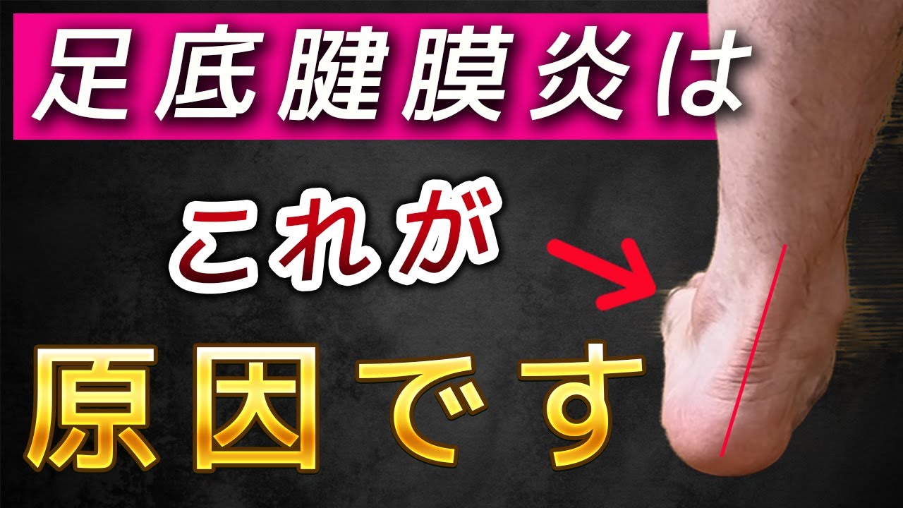 【3分！足底腱膜炎の治し方】踵の傾きを修正して、土踏まずが持ち上がると痛みが改善する？！【足底筋膜炎】