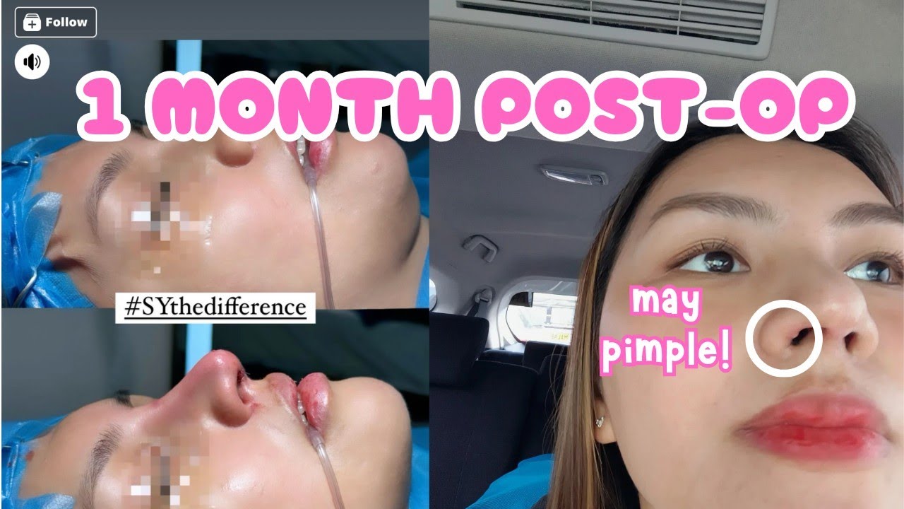 Gusto Magpa-RHINO? WATCH THIS | 1 Month Post-Op | Karenn C.