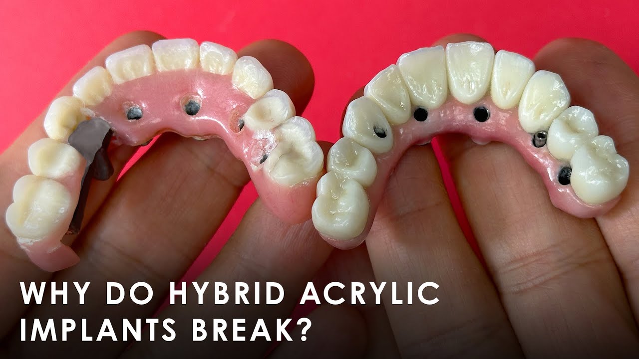 Why Do Hybrid Acrylic Implants Break?