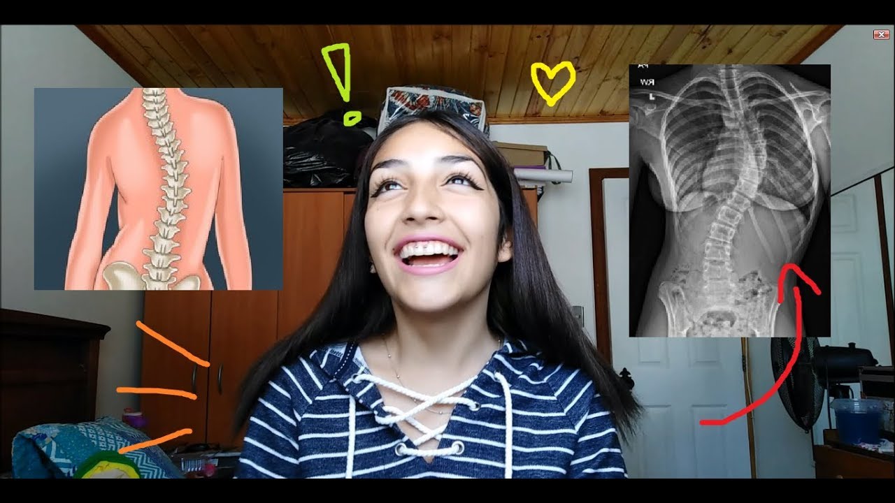 Operación de escoliosis - Mi experiencia 🩷