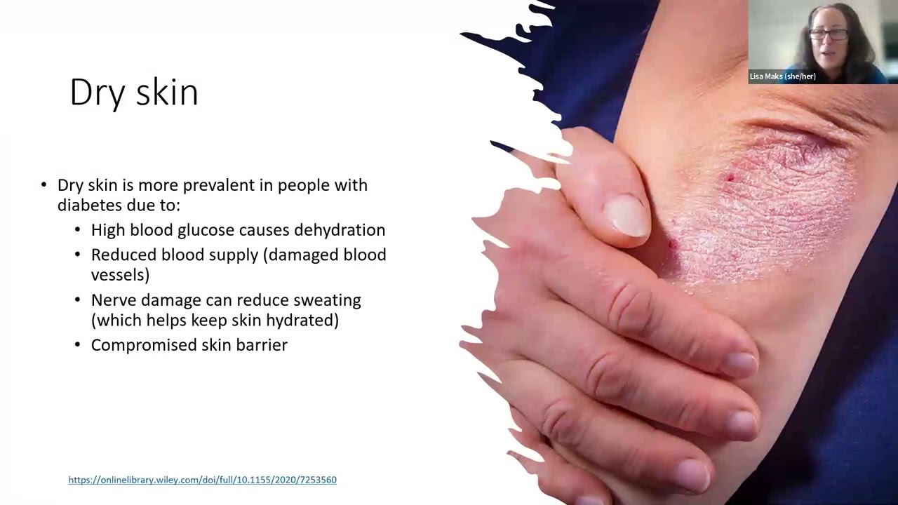 The Relationship Between Skin Conditions and People Living with Diabetes