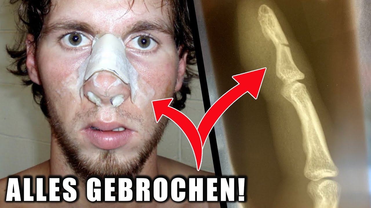 Robert hat sich das GESICHT gebrochen! - Die schlimmsten VERLETZUNGEN auf Expeditionen..