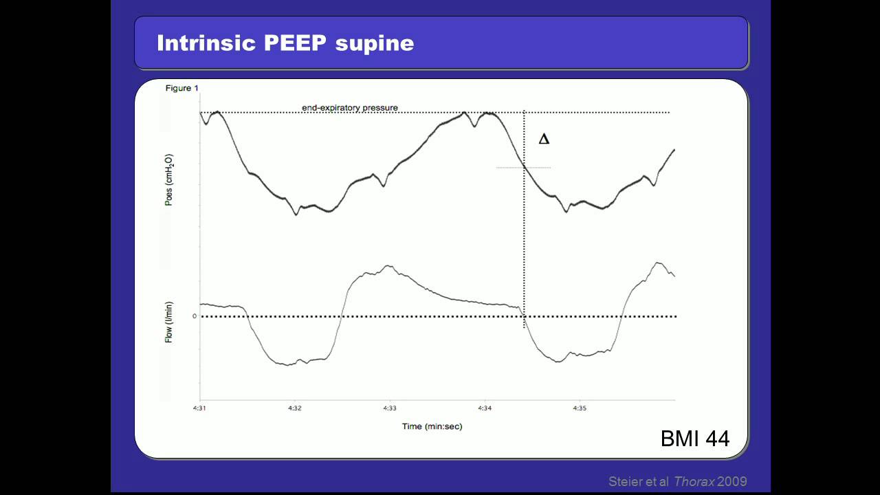 Ventilation in the Obese Patient by Dr Jörg Steier MD (D) PhD (UK)