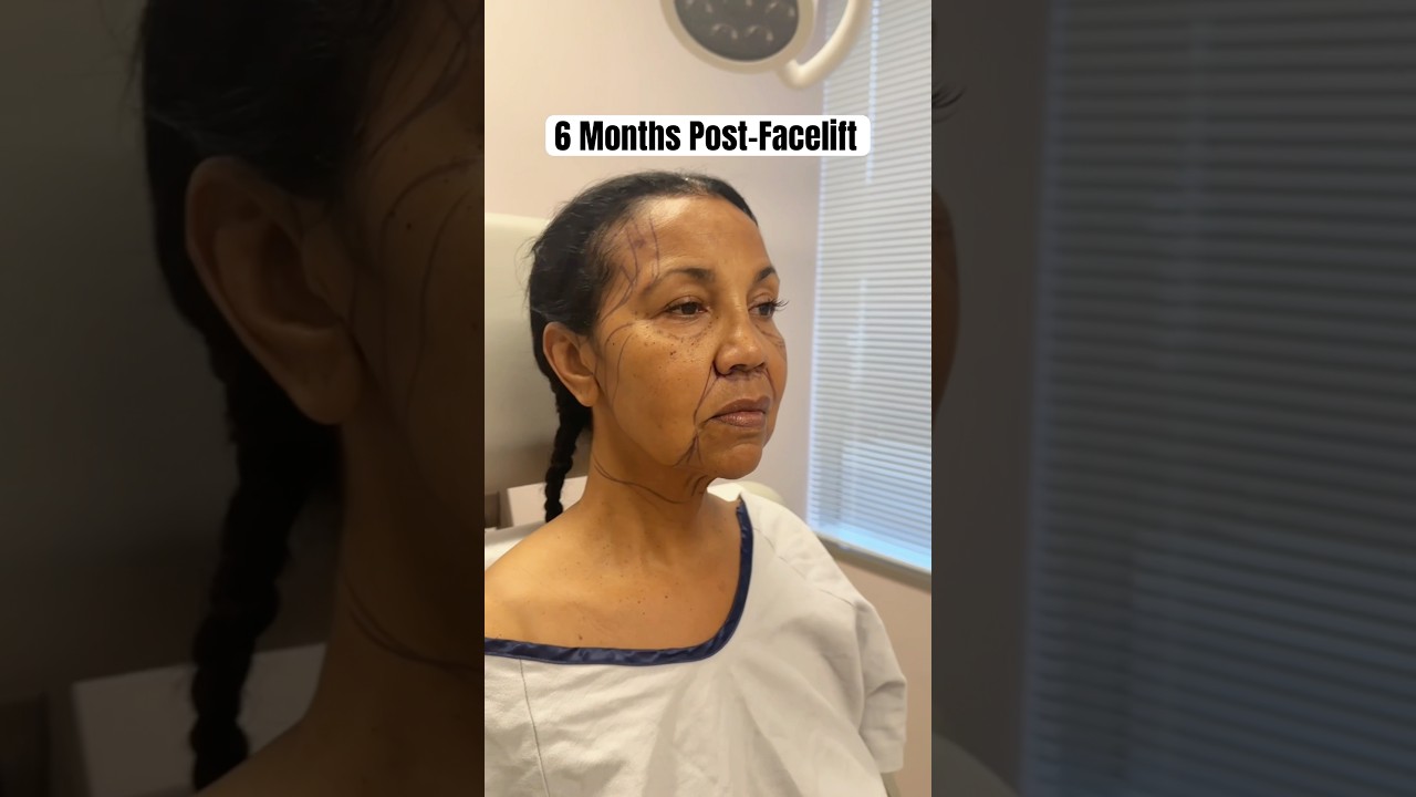 62 Year Old Facelift 🤯 Insane Results 6 Months Post-Op