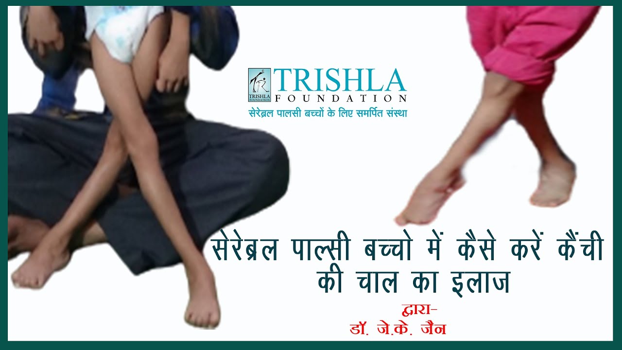 Cerebral Palsy: Causes & Treatment in Scissor Gait (सेरेब्रल पाल्सी में कैंची की चाल का इलाज)| TF