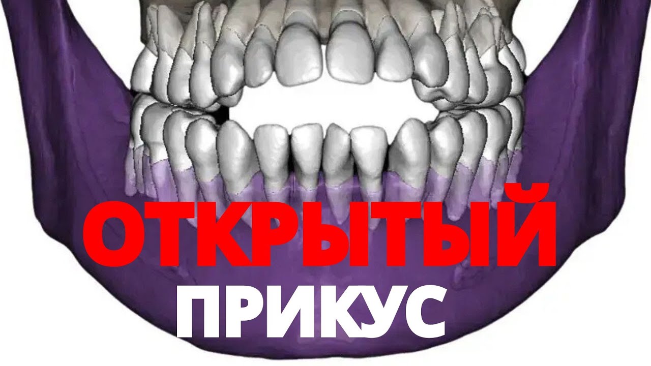 ОТКРЫТЫЙ прикус | Причины. Последствия. Лечение.