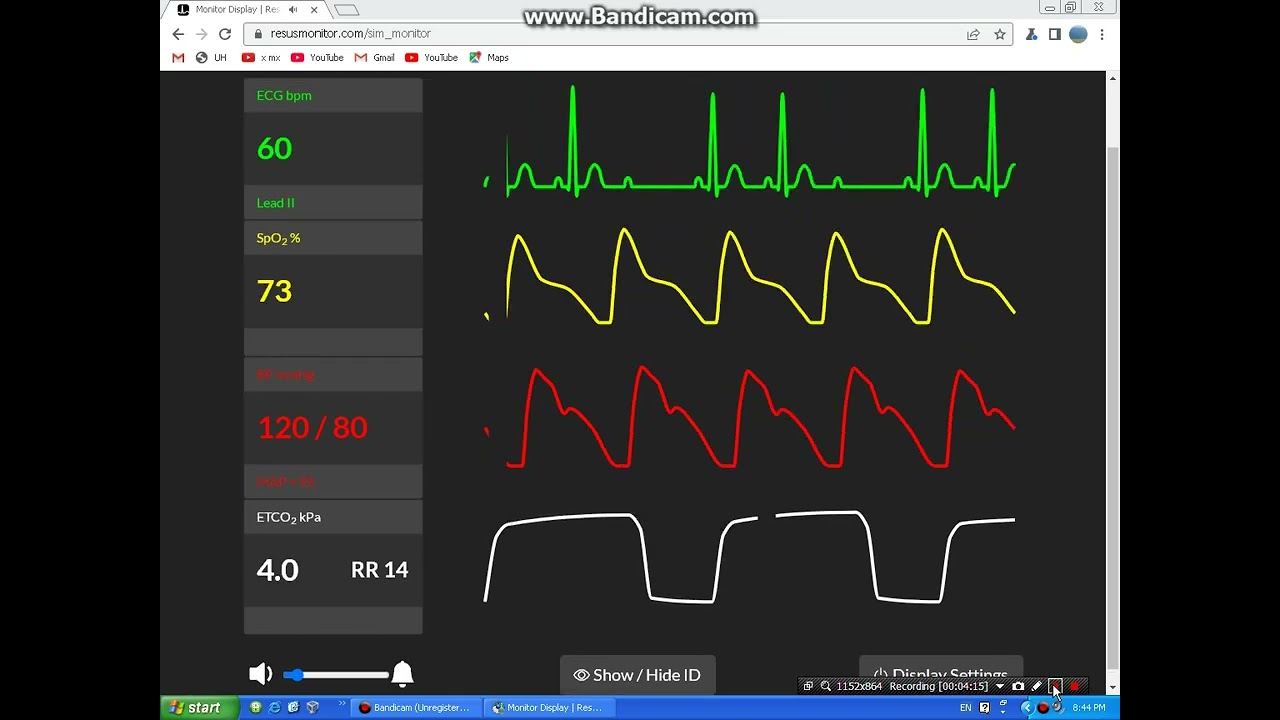 ecg rythms