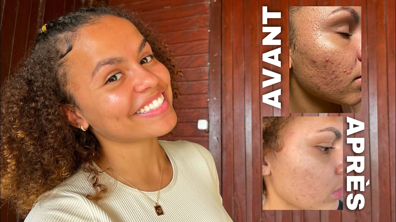 COMMENT J’AI FAIT DISPARAÎTRE MON ACNÉ | ROACCUTANE
