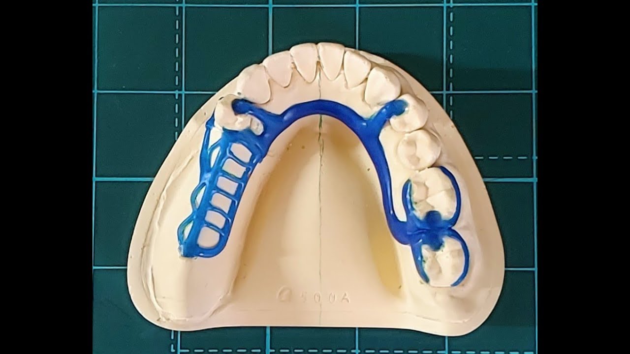Partial Framework Design &
Wax upㆍ77(YG Dental Lab)