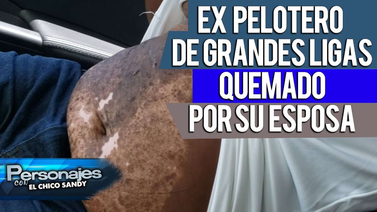 Ex pelotero de grandes ligas quemado por su esposa y sin dinero. PERSONAJES CON CHICO SANDY