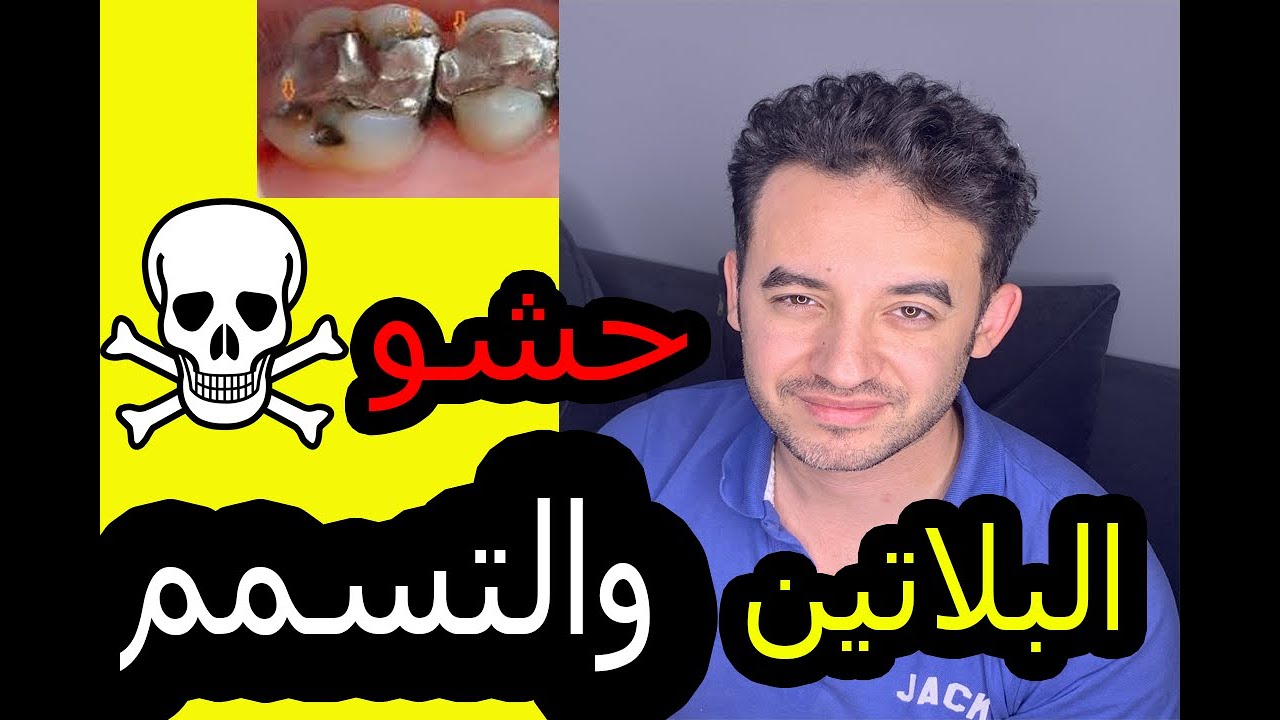 حشو البلاتين وخطر التسمم هل فعلا الحشوة دى ضارة ؟!  مميزات وعيوب  حشو البلاتين