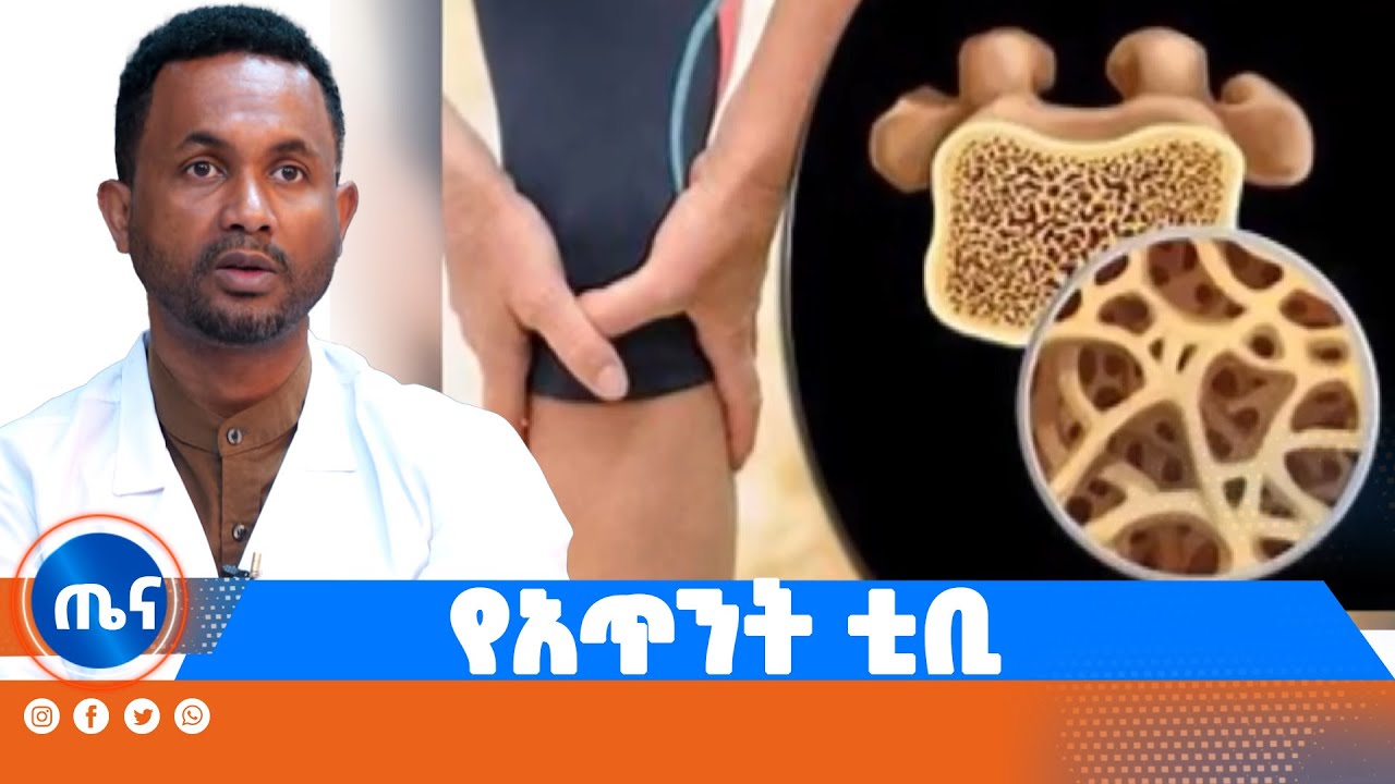 የአጥንት ቲቢ