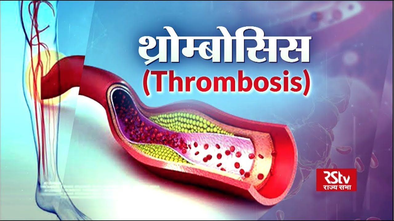 Ayushman Bhavah:  थ्रोम्बोसिस | Thrombosis