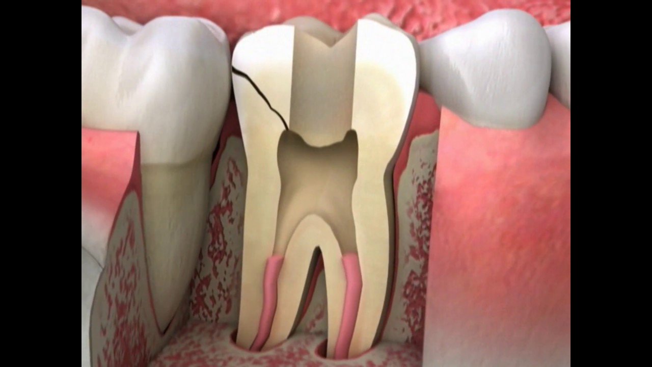 Cracked Tooth Symptoms | Lake Merritt Dental, Oakland, CA