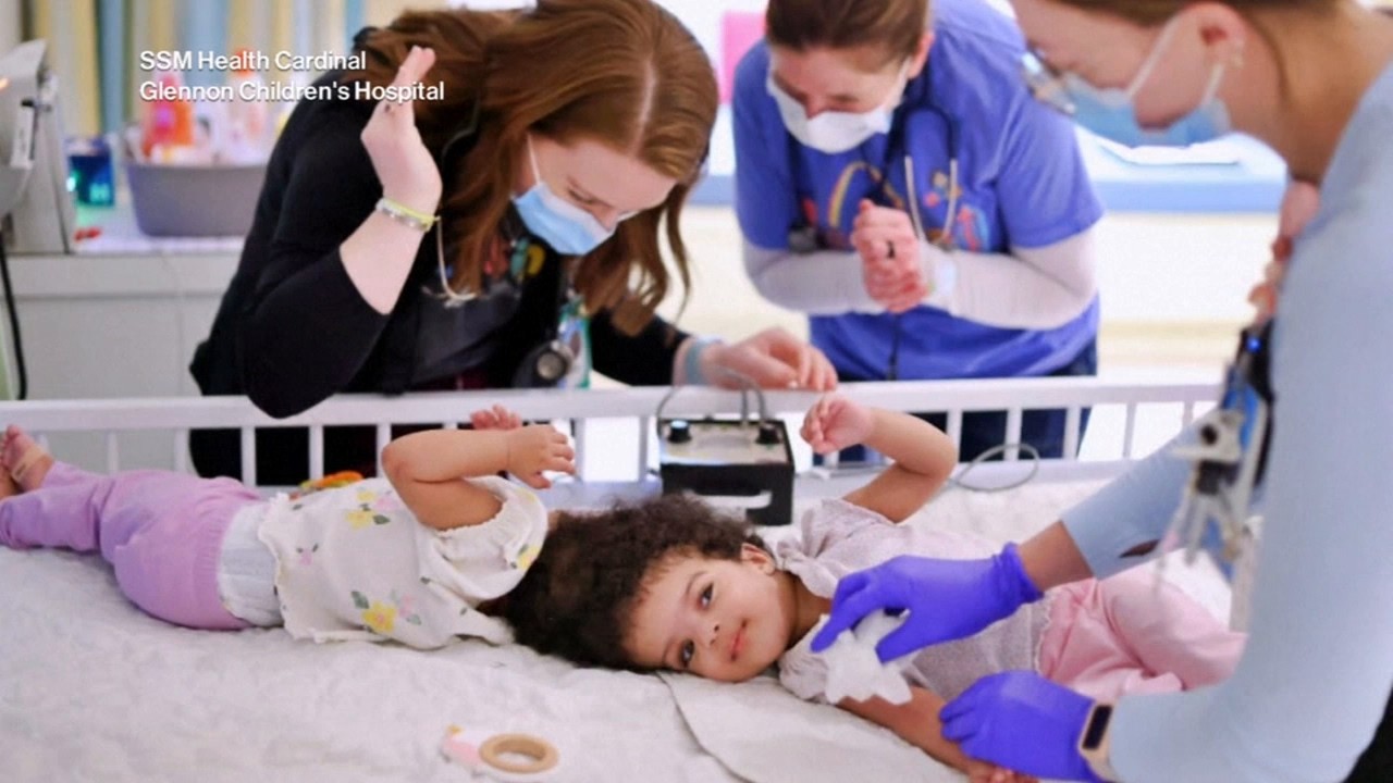 Twin sisters conjoined at head undergo successful separation surgery