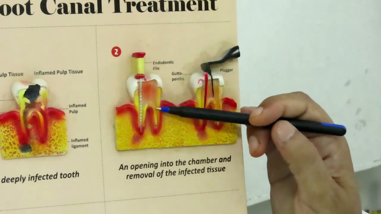 What is Root canal Treatment | Root canal Treatment Procedure - BMCHRC