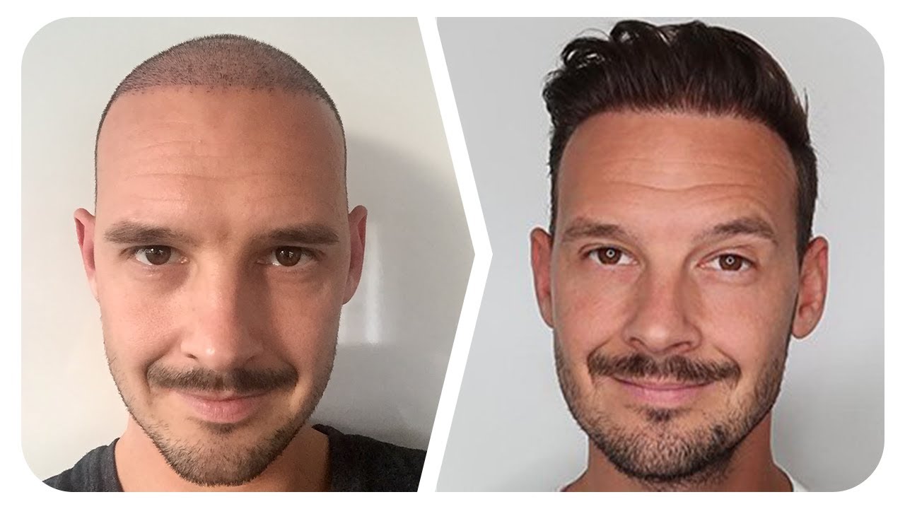 Kay Dittmann spricht über seine Haartransplantation!