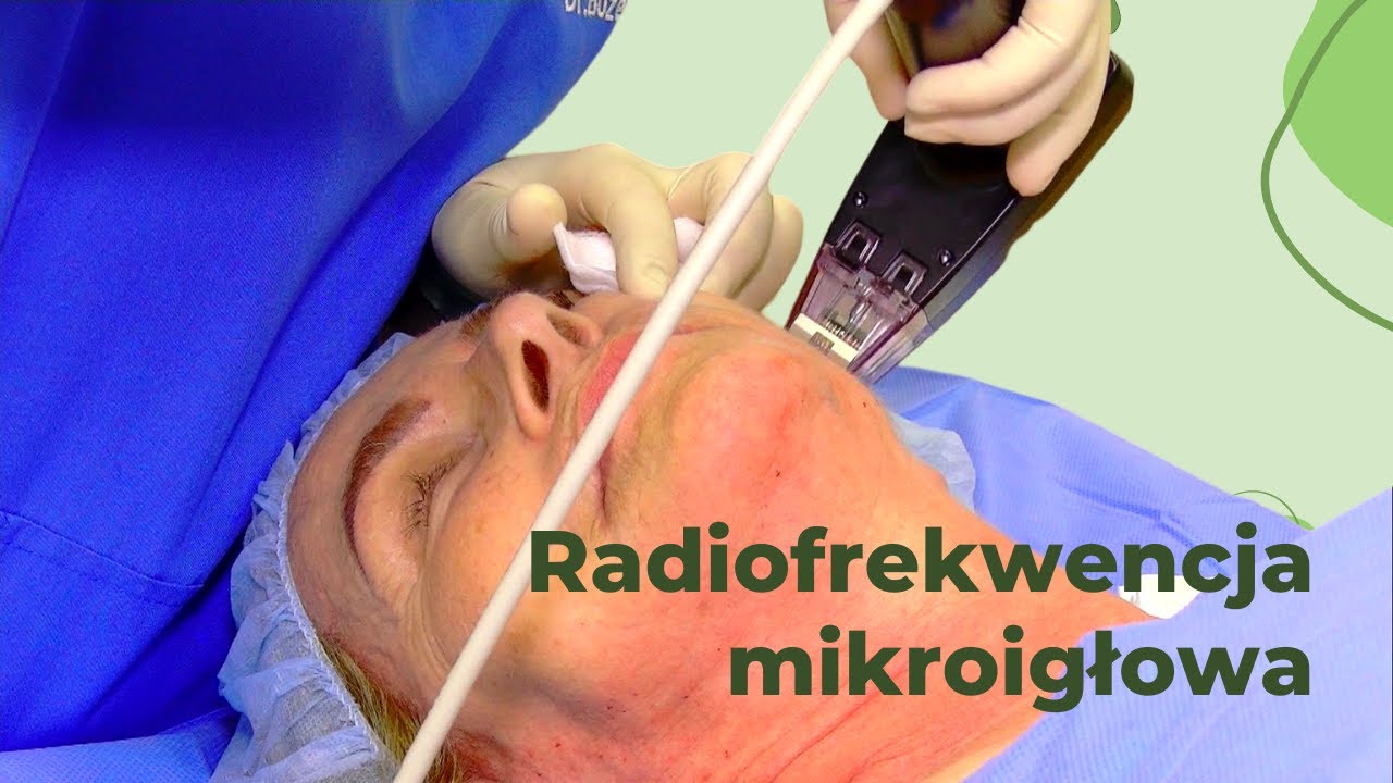 Radiofrekwencja mikroigłowa - zabieg na twarz (prezentacja zabiegu)