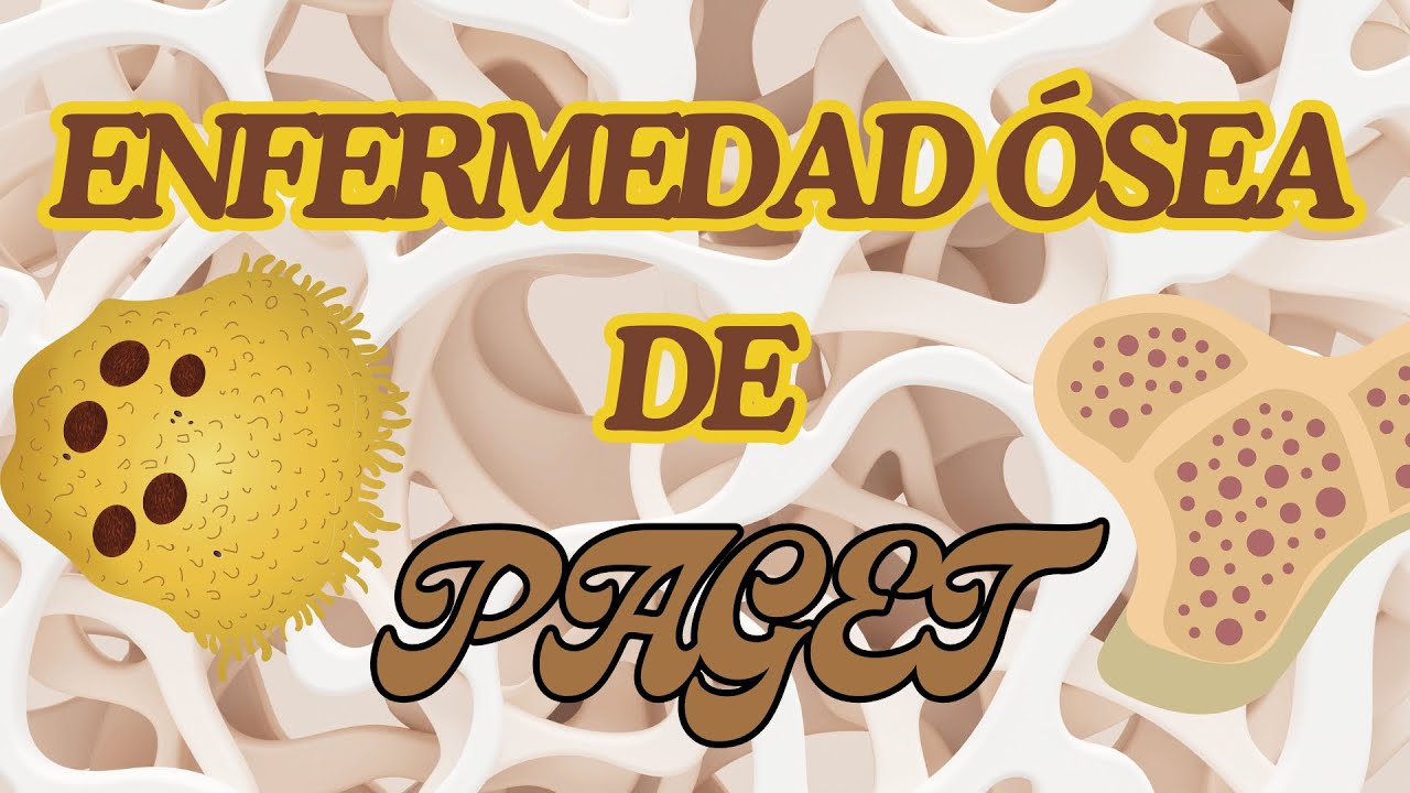 ENFERMEDAD ÓSEA DE PAGET