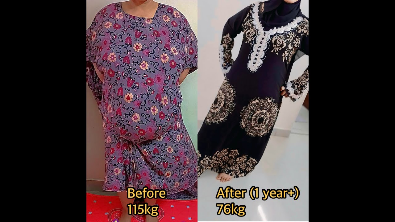 Wafaa Karama weight loss journey before and after Bariatric Surgery by Surgeons001 in Mombasa, Kenya