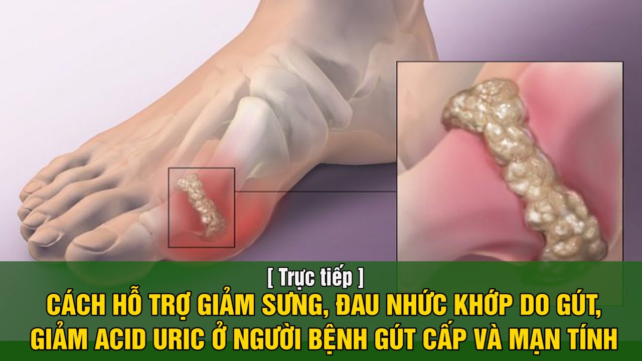 CÁCH HỖ TRỢ GIẢM SƯNG, ĐAU NHỨC KHỚP DO GÚT, GIẢM ACID URIC Ở NGƯỜI BỆNH GÚT CẤP VÀ MẠN TÍNH