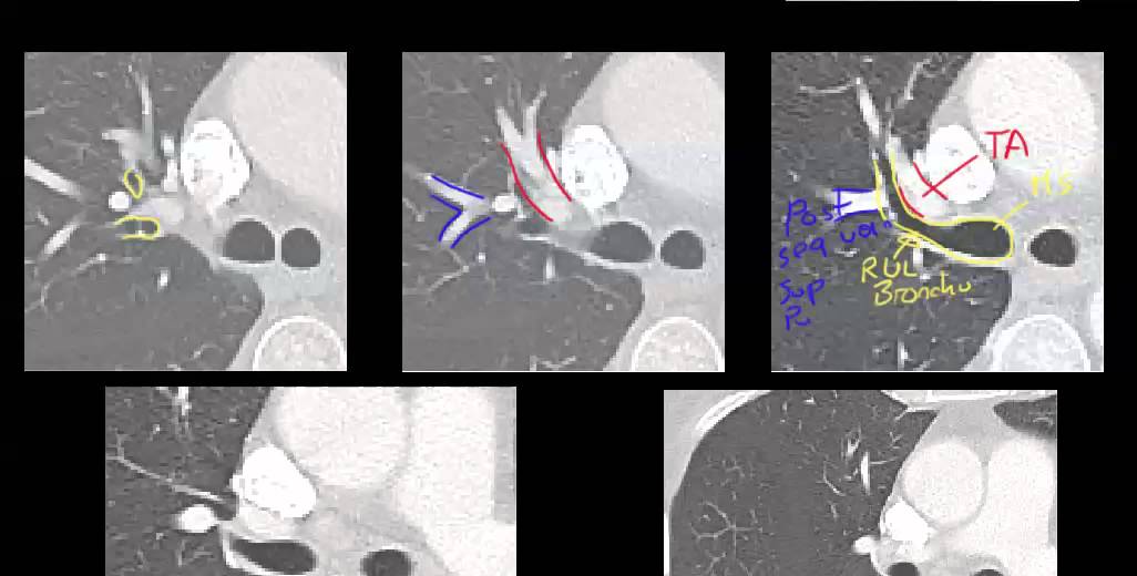 R Hilar lung anatomy on CT