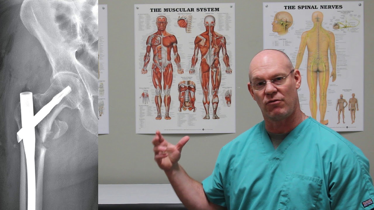Subtrochanteric Fractures | Fracture Friday Episode 31