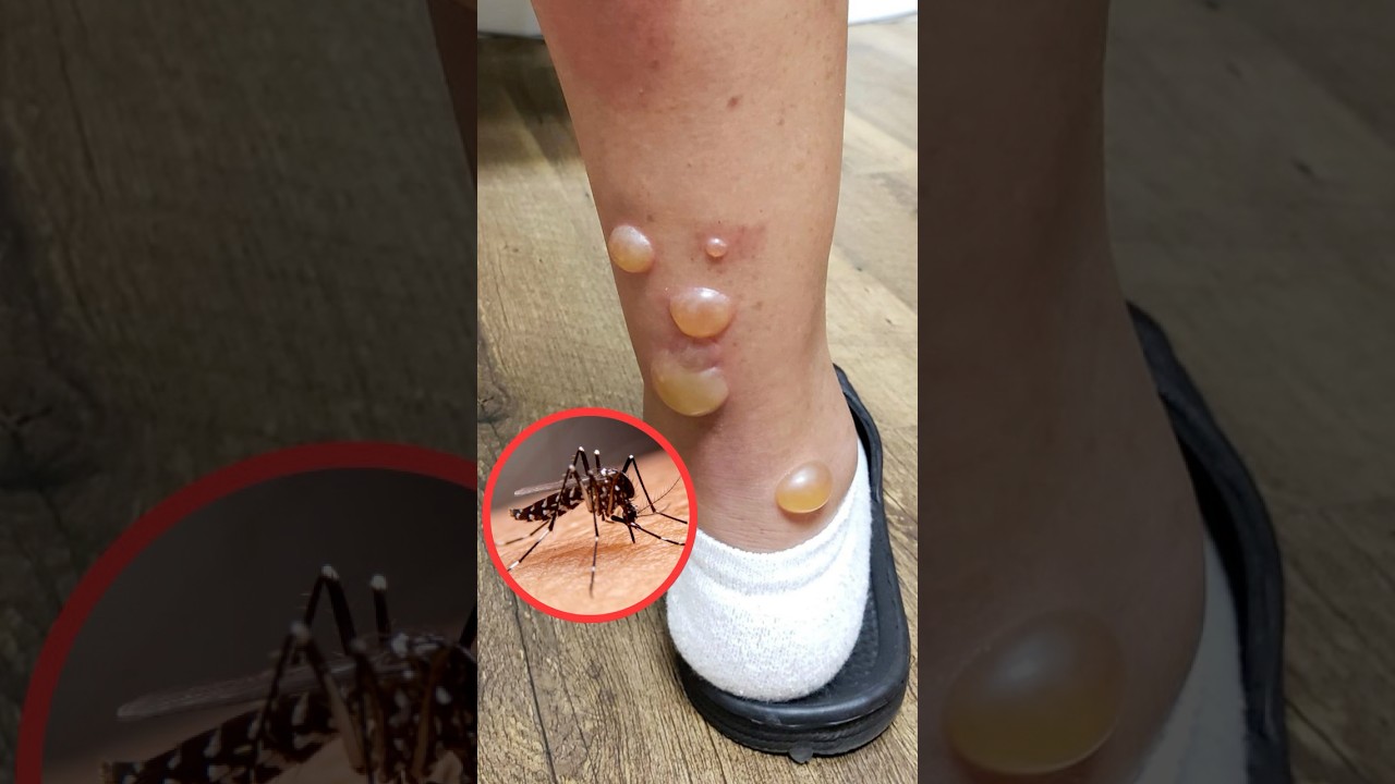 #alergia a los #mosquitos? &ndash; Doctores Especialistas