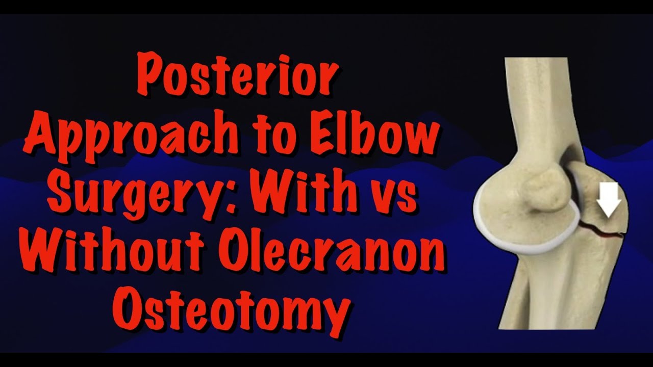 Posterior Approach to Elbow Surgery: With vs Without Olecranon Osteotomy | Dr Deepak Garg