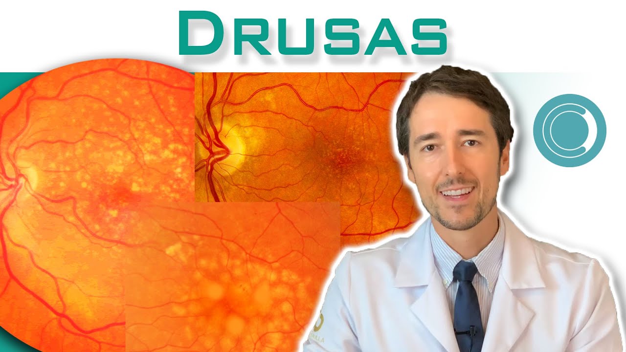 O que s&atilde;o drusas?  Drusas e a degenera&ccedil;&atilde;o macular.