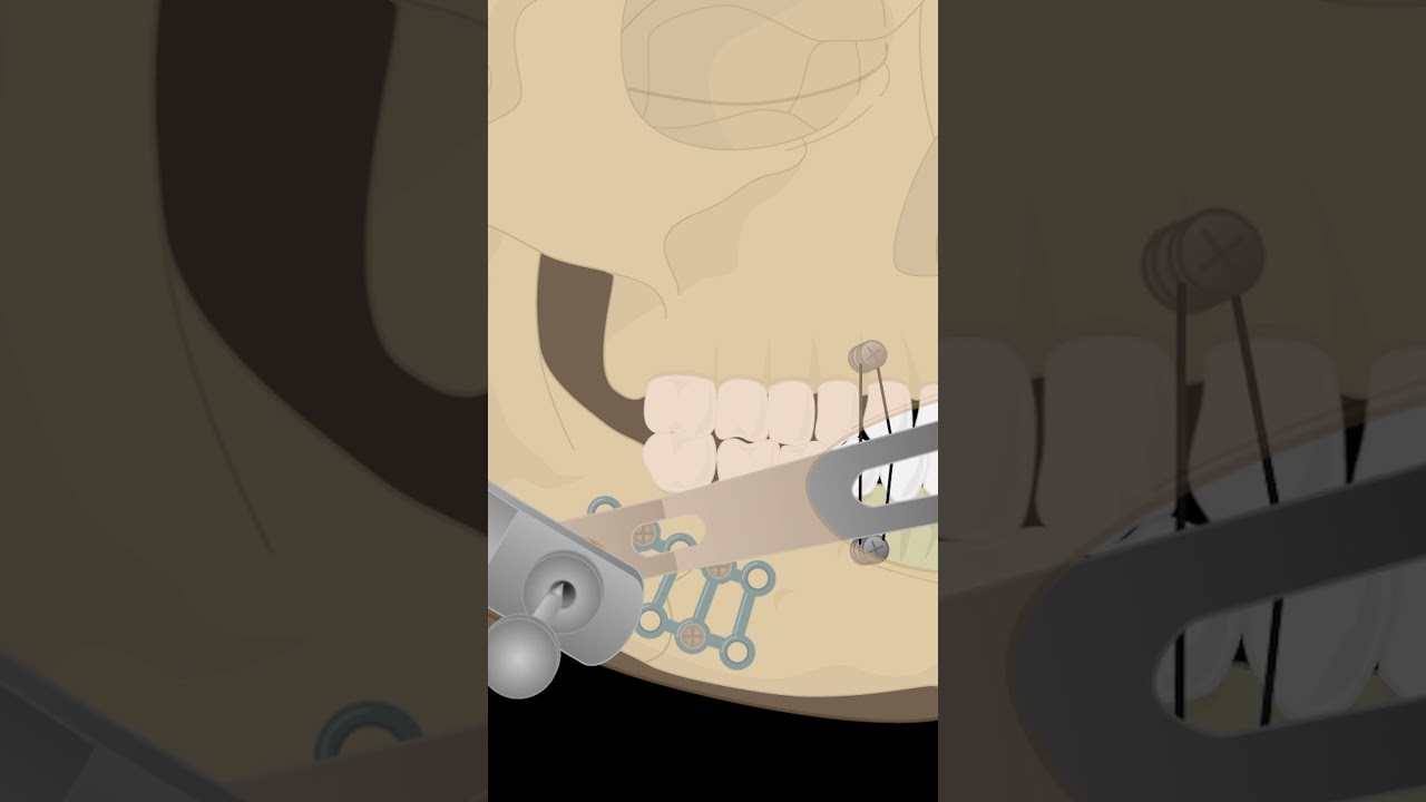 Key Steps for Mandibular Fracture Repair  pt 2 #surgery #fyp #surgeon #jaw #fracture #tooth #ortho