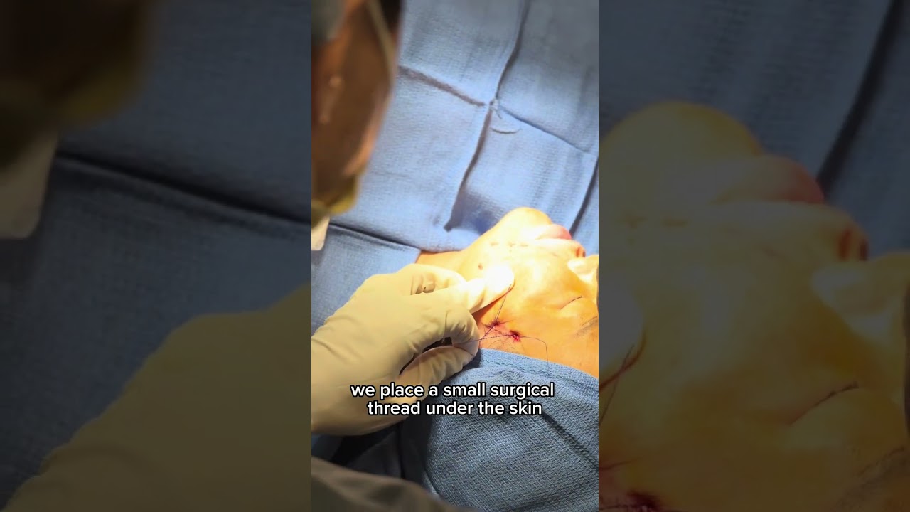 Threadlifting for the face!