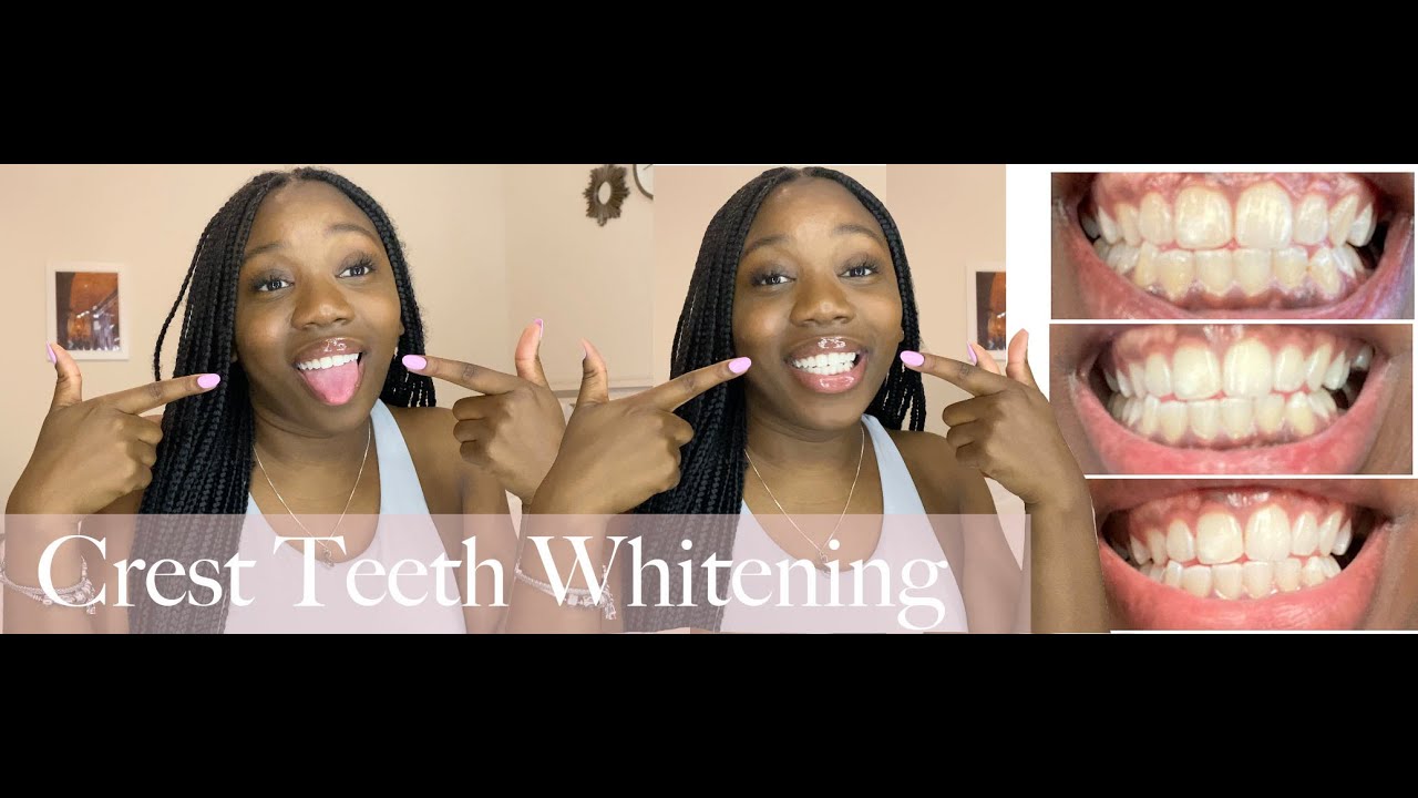 TESTING CREST 3D WHITESTRIPS! | honest review! | 2 week results!