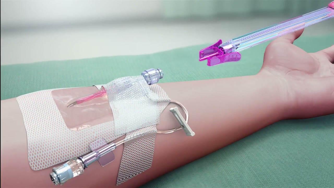 PIVO&trade; Needle-free Blood Collection Device:  Straight IV Catheter System