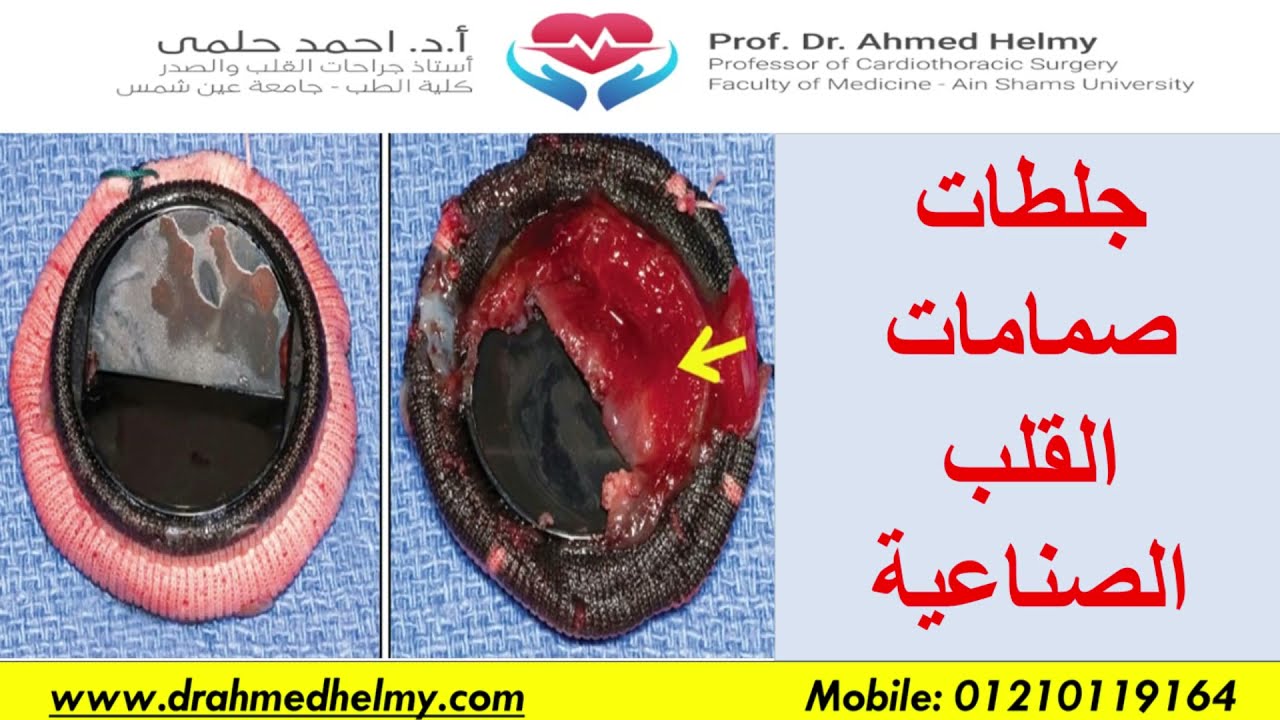 جلطة صمام القلب الصناعى وكيفية الوقاية منها