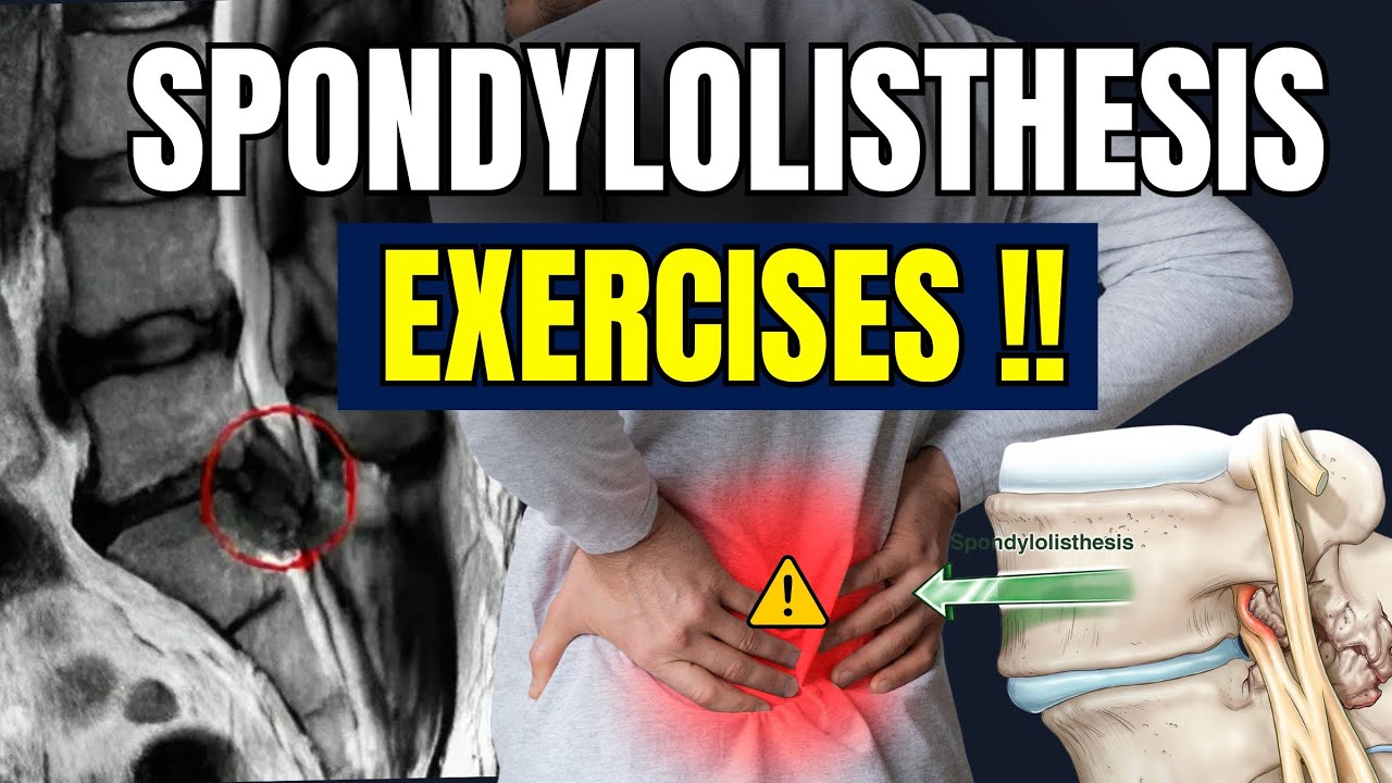 4 Best Exercises for Spondylolisthesis Relief | Safe Back Pain Workout for Spinal Stability