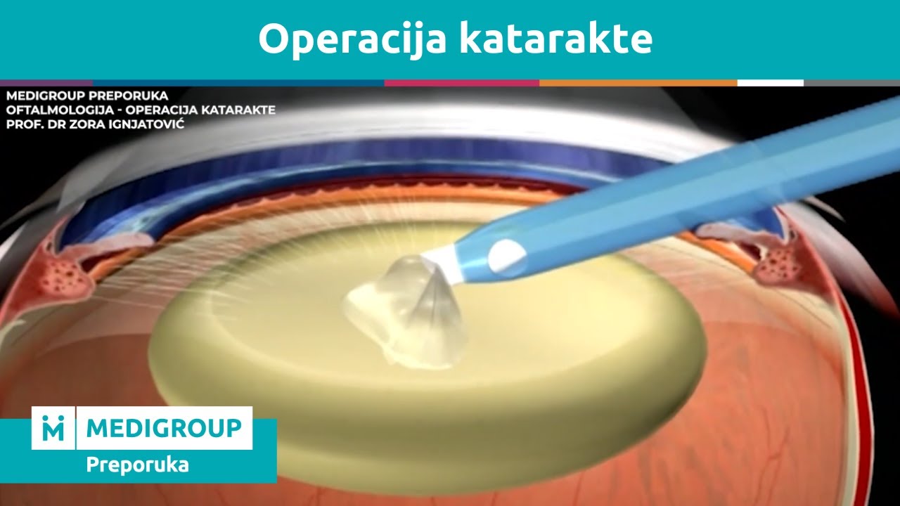 Kako se izvodi operacija katarakte #MediGroupPreporuka