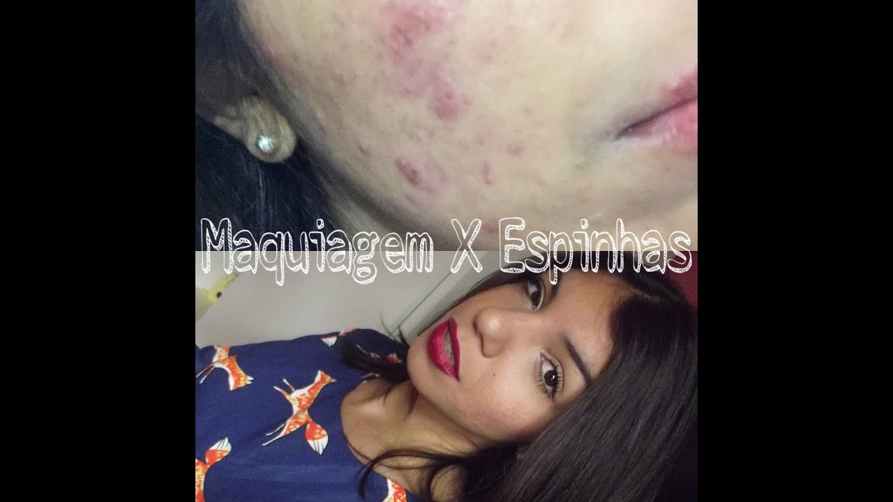 Maquiagem X Espinhas - Camuflando Manchas