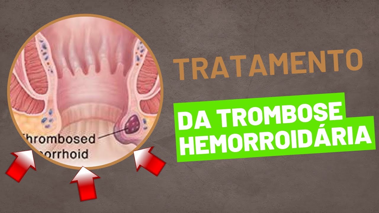 Tratamento da TROMBOSE HEMORROIDÁRIA!