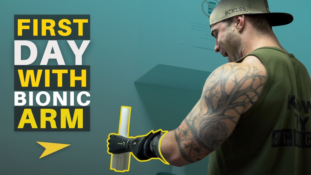 Getting My Prosthetic Hand | Week 1 of Life With A New Hand