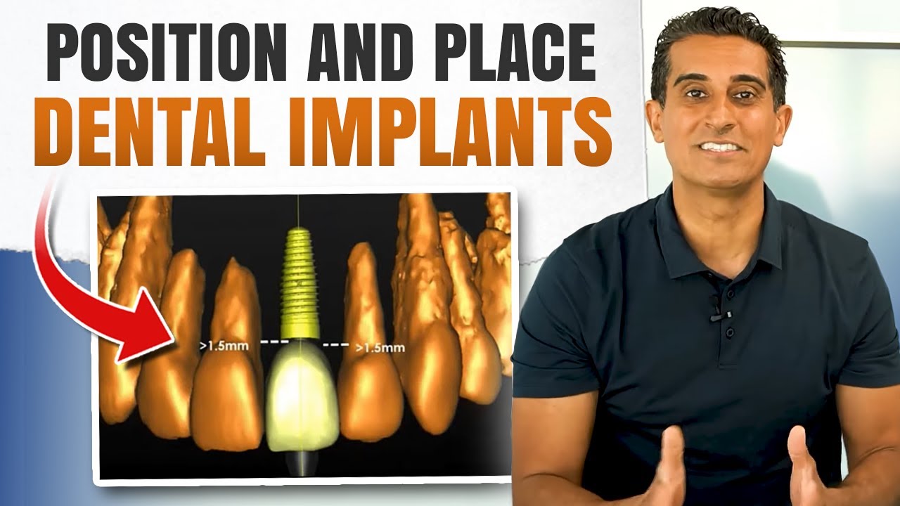 How To Position and Place Dental Implants(Rules and Guidelines)